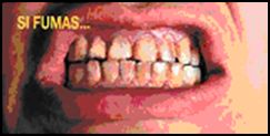 Mexico 2009 Health Effects mouth - mouth cancer, loss of teeth, diseased organ, gross